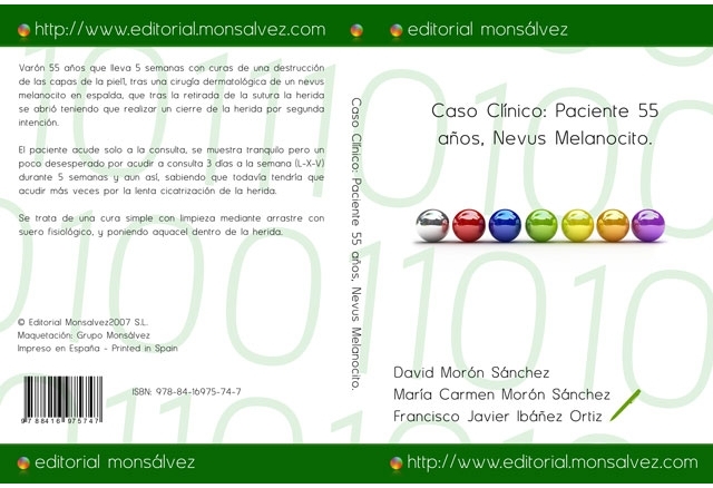 Caso Clínico: Paciente 55 años, Nevus Melanocito.