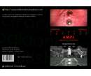 Atrophic Maxilla Palatal Implant A.M.P.I. base teórica y fundamentos