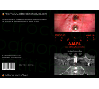 Atrophic Maxilla Palatal Implant A.M.P.I. base teórica y fundamentos