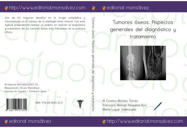 Tumores óseos. Aspectos generales del diagnóstico y tratamiento
